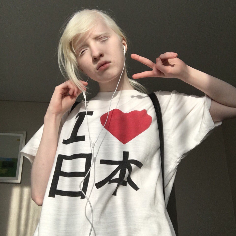 アルビノの芸能人とモデル22人！日本人の割合も解説【メラニン色素がない】