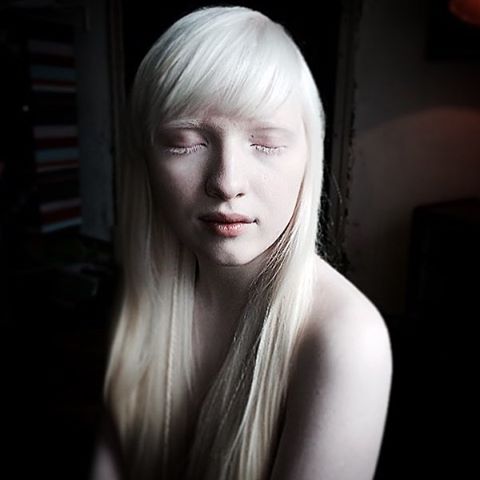 アルビノの芸能人とモデル22人！日本人の割合も解説【メラニン色素がない】